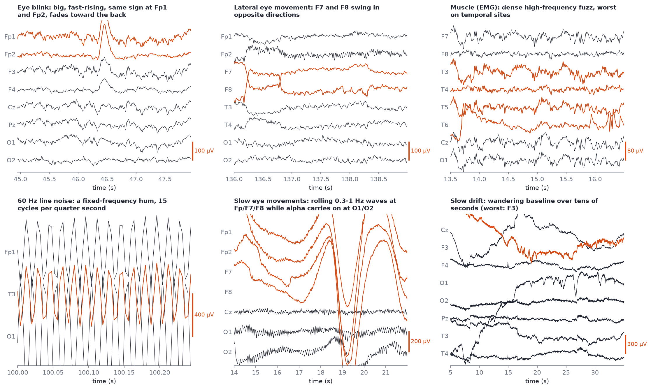Six panels of real artifacts: blink, lateral eye movement, muscle, 60 Hz line noise, slow eye movements, slow drift